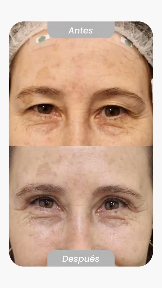 Antes y después real de blefaroplastia realizada por la Dra. Columbié