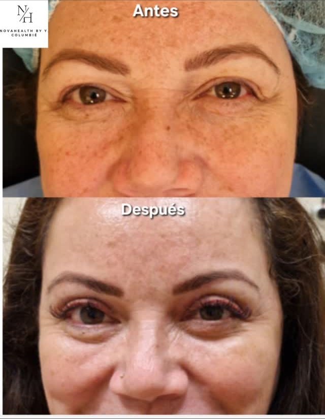 Resultado de blefaroplastia superior e inferior en paciente real